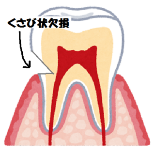くさび状欠損